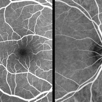 Smart OCT Angiography Solution